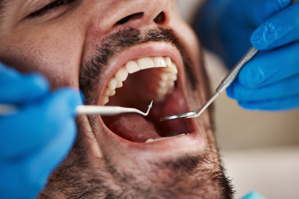 Best Emergency Tooth Extraction in Camp Hill, PA